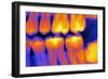 Teeth with Fillings, X-ray-PASIEKA-Framed Photographic Print