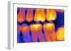 Teeth with Fillings, X-ray-PASIEKA-Framed Photographic Print