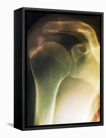 Tendinitis of the Shoulder, X-ray-ZEPHYR-Framed Stretched Canvas