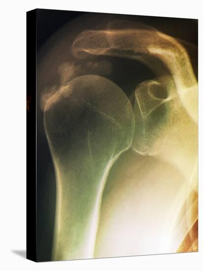 Tendinitis of the Shoulder, X-ray-ZEPHYR-Stretched Canvas