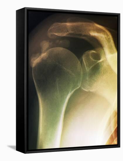 Tendinitis of the Shoulder, X-ray-ZEPHYR-Framed Stretched Canvas