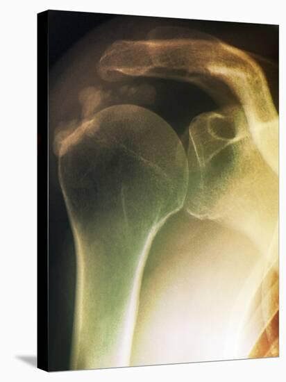 Tendinitis of the Shoulder, X-ray-ZEPHYR-Stretched Canvas
