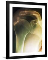 Tendinitis of the Shoulder, X-ray-ZEPHYR-Framed Photographic Print