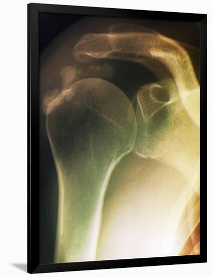 Tendinitis of the Shoulder, X-ray-ZEPHYR-Framed Photographic Print