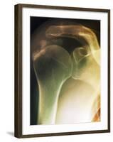 Tendinitis of the Shoulder, X-ray-ZEPHYR-Framed Photographic Print