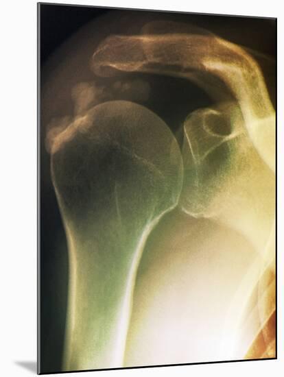 Tendinitis of the Shoulder, X-ray-ZEPHYR-Mounted Photographic Print