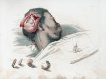 View of Wound in Skull after Trephination and Removal of Shattered Bone Piece at Bottom Left, 1821-Thomas Landseer-Giclee Print