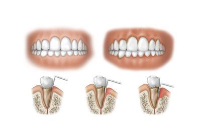 'Three Stages of Periodontal Disease' Prints | AllPosters.com