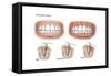 Three Stages of Periodontal Disease-null-Framed Stretched Canvas