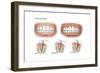 Three Stages of Periodontal Disease-null-Framed Premium Giclee Print