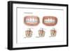 Three Stages of Periodontal Disease-null-Framed Premium Giclee Print