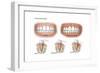 Three Stages of Periodontal Disease-null-Framed Premium Giclee Print