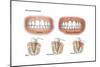 Three Stages of Periodontal Disease-null-Mounted Premium Giclee Print