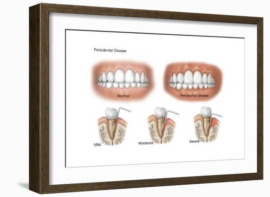 Three Stages of Periodontal Disease-null-Framed Art Print