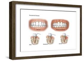 Three Stages of Periodontal Disease-null-Framed Art Print