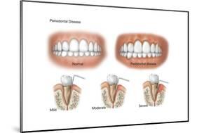 Three Stages of Periodontal Disease-null-Mounted Art Print