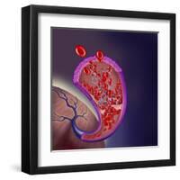 Thrombus Forming on Valve Within Vein-null-Framed Art Print