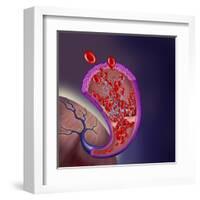 Thrombus Forming on Valve Within Vein-null-Framed Art Print