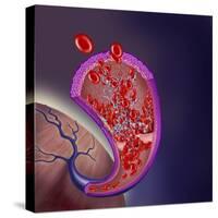 Thrombus Forming on Valve Within Vein-null-Stretched Canvas