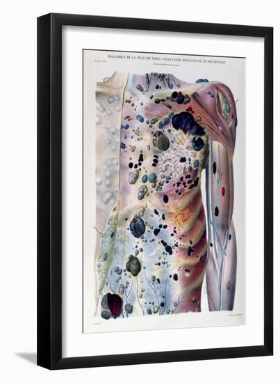 Tumours and Cancerous Tubercles, from Anatomie Pathologique du Corps Humain by Jean Cruveilhier-Antoine Chazal-Framed Giclee Print