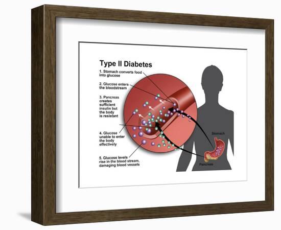 Type 2 Diabetes-Gwen Shockey-Framed Art Print