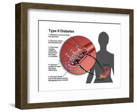 Type 2 Diabetes-Gwen Shockey-Framed Art Print