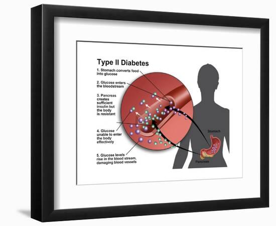 Type 2 Diabetes-Gwen Shockey-Framed Art Print