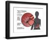 Type 2 Diabetes-Gwen Shockey-Framed Art Print