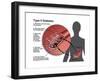 Type 2 Diabetes-Gwen Shockey-Framed Art Print