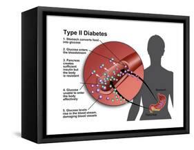 Type 2 Diabetes-Gwen Shockey-Framed Stretched Canvas