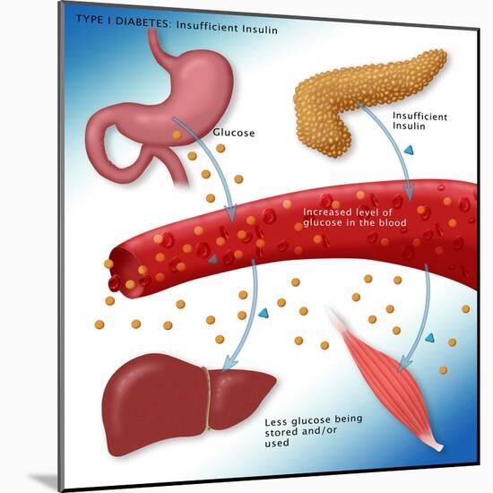 Type I Diabetes-Monica Schroeder-Mounted Giclee Print