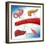 Type II Diabetes-Monica Schroeder-Framed Giclee Print