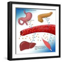 Type II Diabetes-Monica Schroeder-Framed Giclee Print