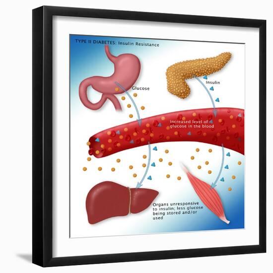 Type II Diabetes-Monica Schroeder-Framed Giclee Print