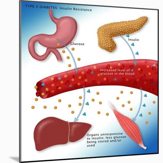 Type II Diabetes-Monica Schroeder-Mounted Giclee Print