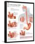 Understanding GERD Educational Disease Chart Poster-null-Framed Poster