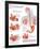 Understanding GERD Educational Disease Chart Poster-null-Framed Poster