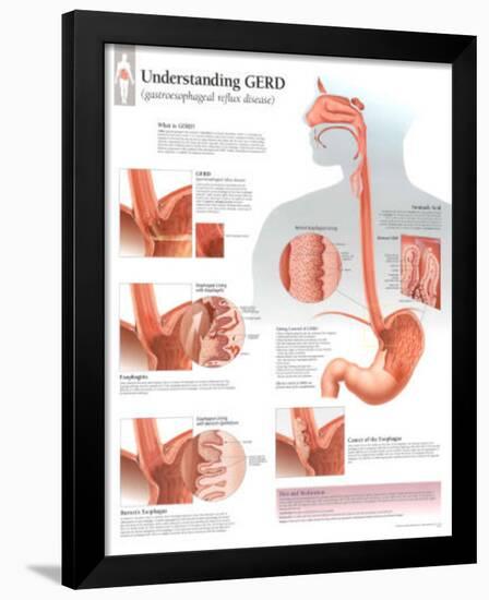 Understanding GERD Educational Disease Chart Poster-null-Framed Poster