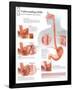 Understanding GERD Educational Disease Chart Poster-null-Framed Poster