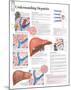 Understanding Hepatitis Educational Chart Poster-null-Mounted Poster