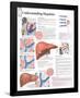 Understanding Hepatitis Educational Chart Poster-null-Framed Poster