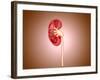 Ureteropelvic Junction (Upj) Obstruction in the Kidney-null-Framed Art Print