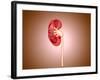 Ureteropelvic Junction (Upj) Obstruction in the Kidney-null-Framed Art Print