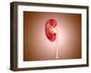 Ureteropelvic Junction (Upj) Obstruction in the Kidney-null-Framed Art Print