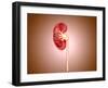 Ureteropelvic Junction (Upj) Obstruction in the Kidney-null-Framed Art Print