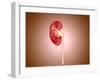 Ureteropelvic Junction (Upj) Obstruction in the Kidney-null-Framed Art Print