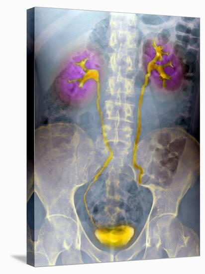 Urinary System, X-ray-Du Cane Medical-Stretched Canvas