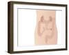 Urostomy Procedure, Artwork-Peter Gardiner-Framed Photographic Print