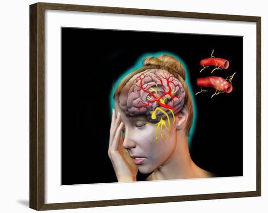 Vascular Causes of Headaches-Jose Antonio-Framed Photographic Print