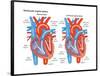 Ventricular Septal Defect-Encyclopaedia Britannica-Framed Poster